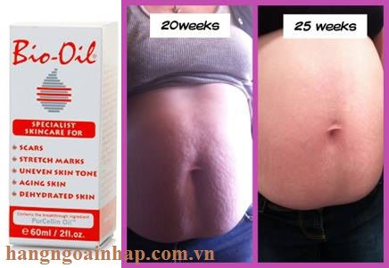 Tinh Dầu Chống rạn da Bio-Oil 60ml của Úc