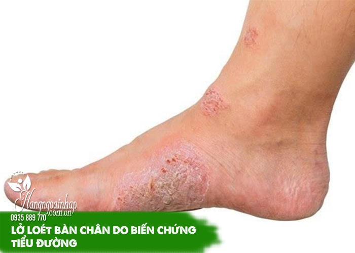 Biến chứng nguy hiểm của bệnh tiểu đường bạn nên biết 7