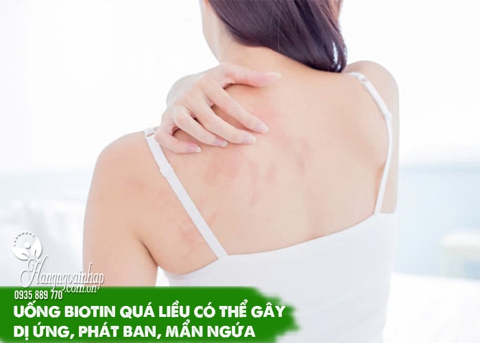 Tác dụng phụ khi uống Biotin có thể bạn chưa biết  08