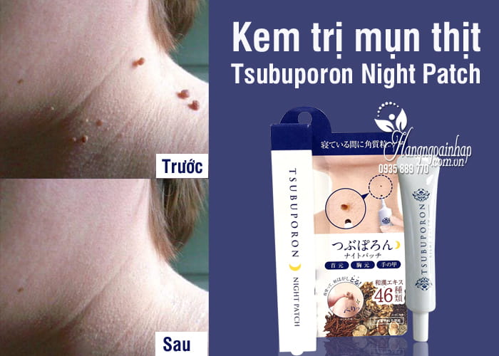 Kem trị mụn thịt Tsubuporon Night Patch 20g của Nhật, cho body 2