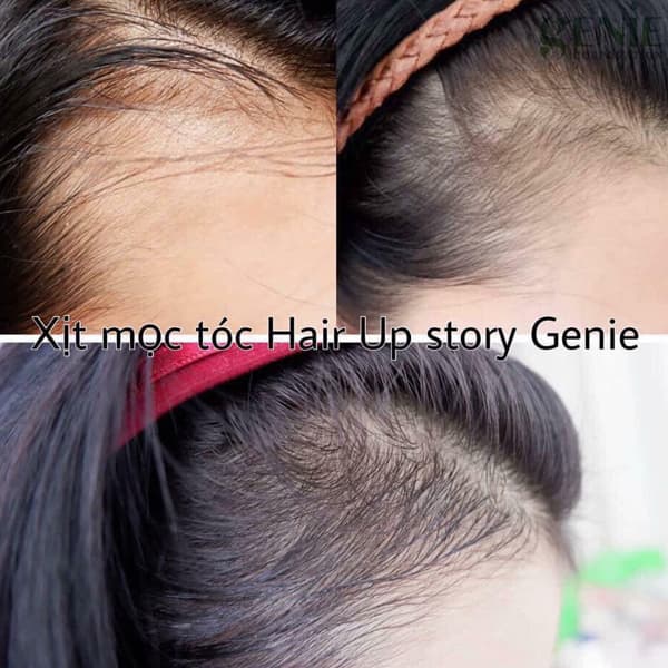Xịt mọc tóc Hàn Quốc: Nếu bạn muốn tóc của mình mọc nhanh và dày hơn, hãy thử xịt mọc tóc Hàn Quốc. Sản phẩm này sẽ giúp kích thích tóc mọc, ngăn ngừa rụng tóc và cải thiện sức khỏe của tóc. Hãy xem hình ảnh để hiểu rõ hơn về sản phẩm này và quyết định chọn cho mình một chai xịt mọc tóc Hàn Quốc chất lượng nhất nhé.
