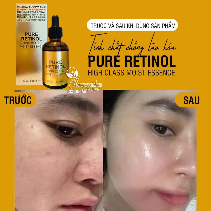 Tinh chất chống lão hóa Pure Retinol High Class Moist Essence