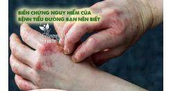 Biến chứng nguy hiểm của bệnh tiểu đường bạn nên biết