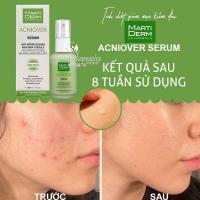 Tinh chất giảm mụn kiềm dầu MartiDerm Acniover Serum 30ml